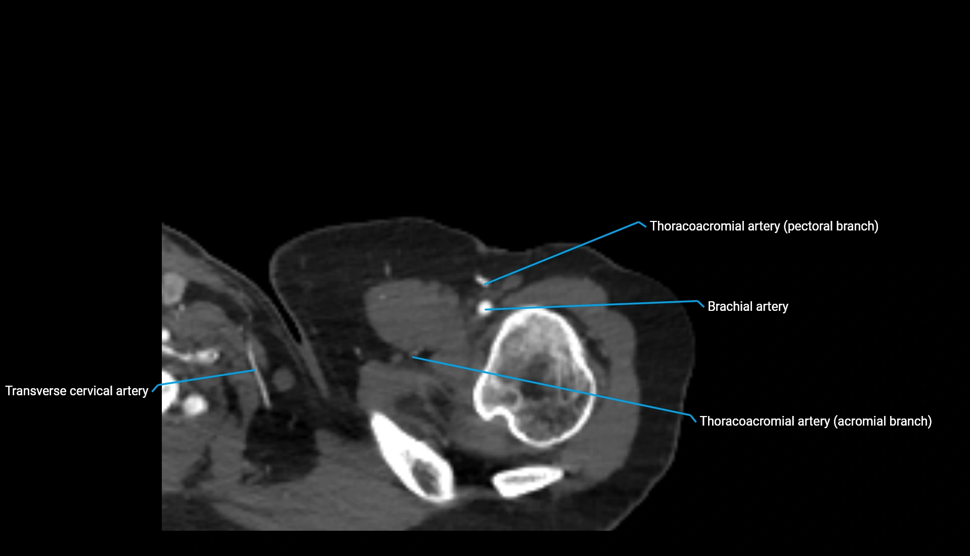 CTA upper limb axial cross sectional anatomy labelled image 320 (1).webp